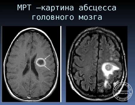 МРТ абсцесса головного мозга
