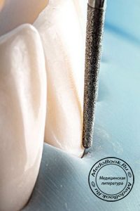 Создание первичных условий для прочности стенок зуба при препарировании кариозных поражений