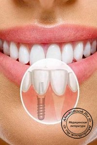 Выгода и преимущества имплантации зубов