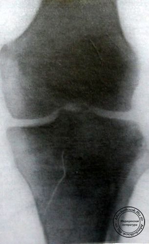Перелом внутреннего мыщелка большеберцовой кости задний снимок