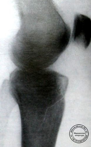 Перелом внутреннего мыщелка большеберцовой кости боковой снимок