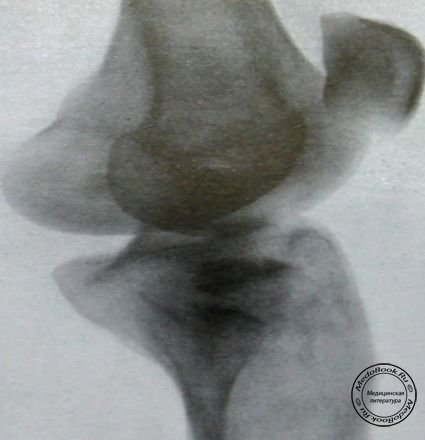 Депрессионный перелом наружного мыщелка большеберцовой кости боковой снимок