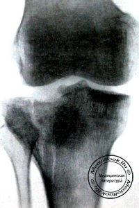 Переломы мыщелков большеберцовой кости
